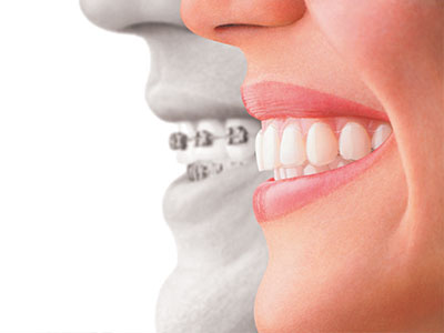 Granger Dentistry | Digital Radiography, Dental Fillings and Inlays  amp  Onlays