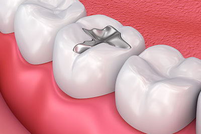 Granger Dentistry | Emergency Treatment, LANAP reg  and Implant Dentistry