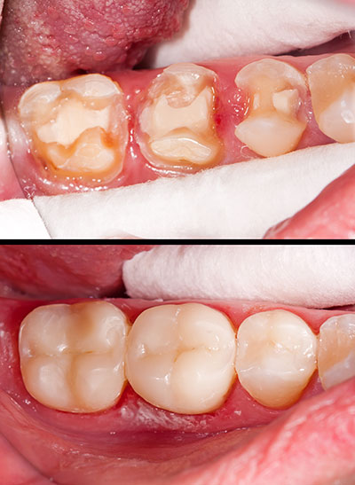 Granger Dentistry | CBCT, E4D and Inlays  amp  Onlays
