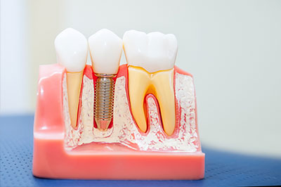Granger Dentistry | Periodontal Treatment, Dental Sealants and Oral Cancer Screening
