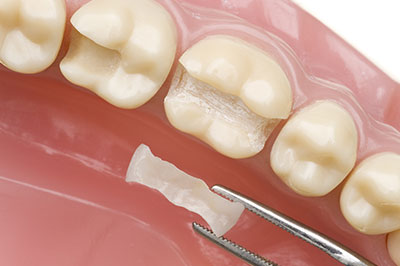 Granger Dentistry | Crowns  amp  Caps, Sedation Dentistry and Inlays  amp  Onlays