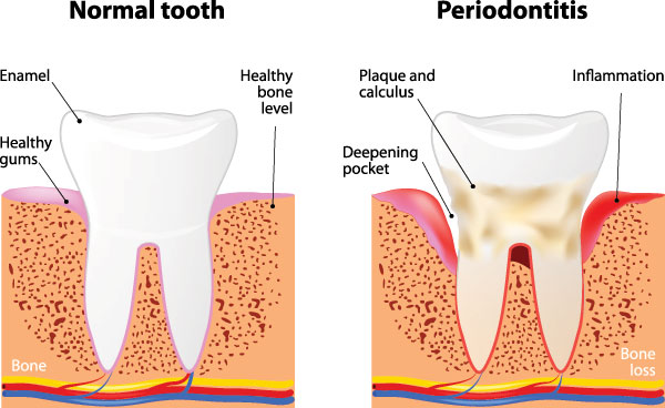 Granger Dentistry | Dental Cleanings, Dental Bridges and Oral Cancer Screening