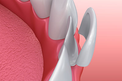 Granger Dentistry | Root Canals, Emergency Treatment and Sports Mouthguards