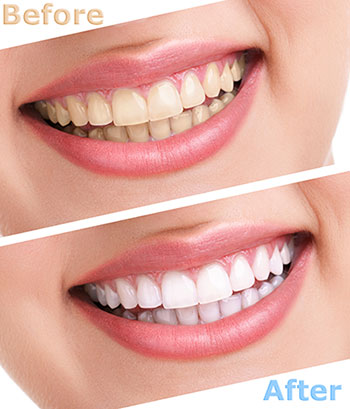 Granger Dentistry | Crowns  amp  Caps, All-on-4 reg  and Digital Impressions