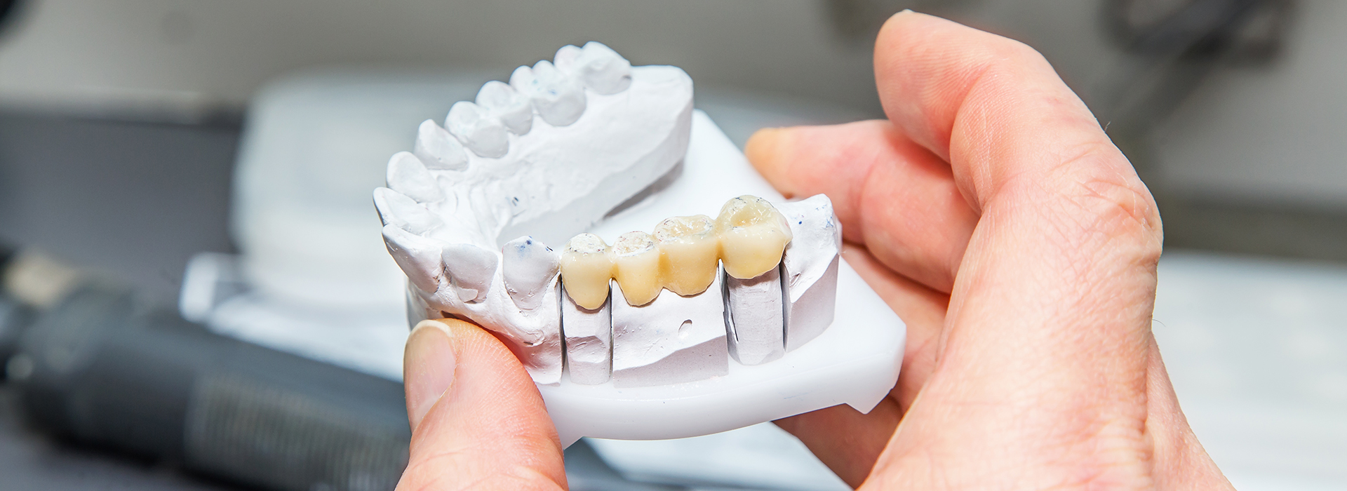 Granger Dentistry | Teeth Whitening, Dental Bridges and Ceramic Crowns