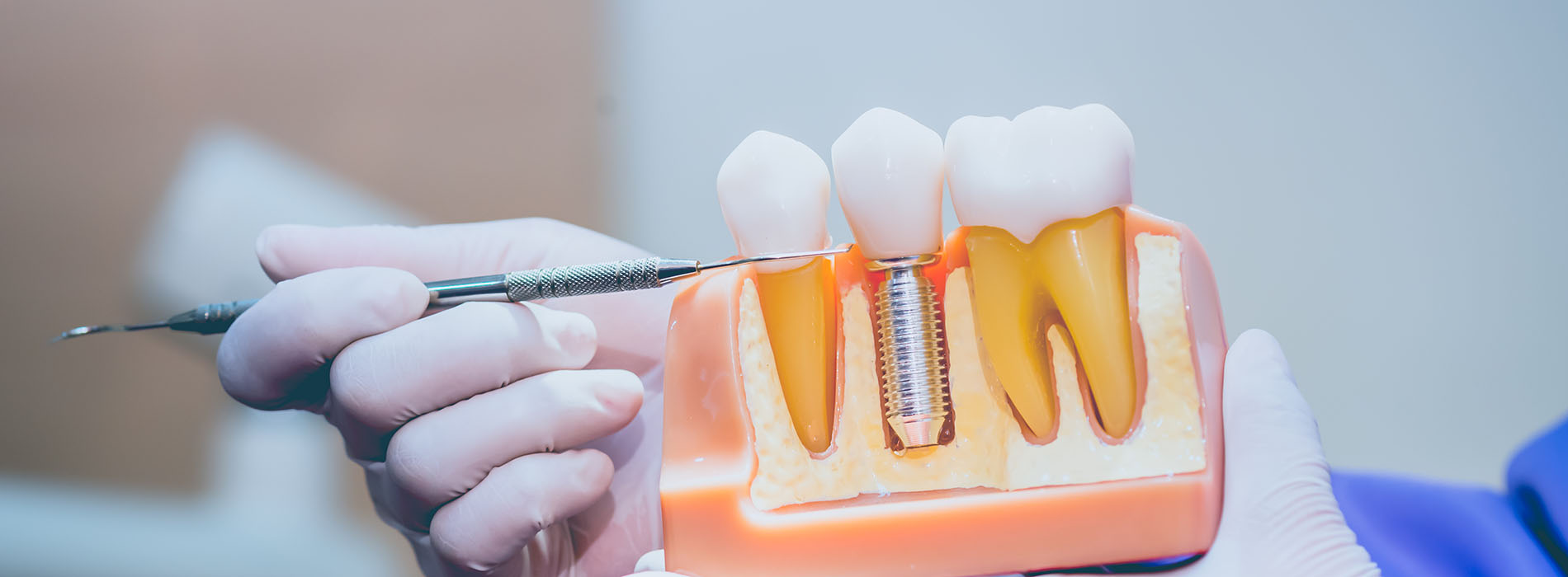 Granger Dentistry | Digital Impressions, Night Guards and Implant Dentistry