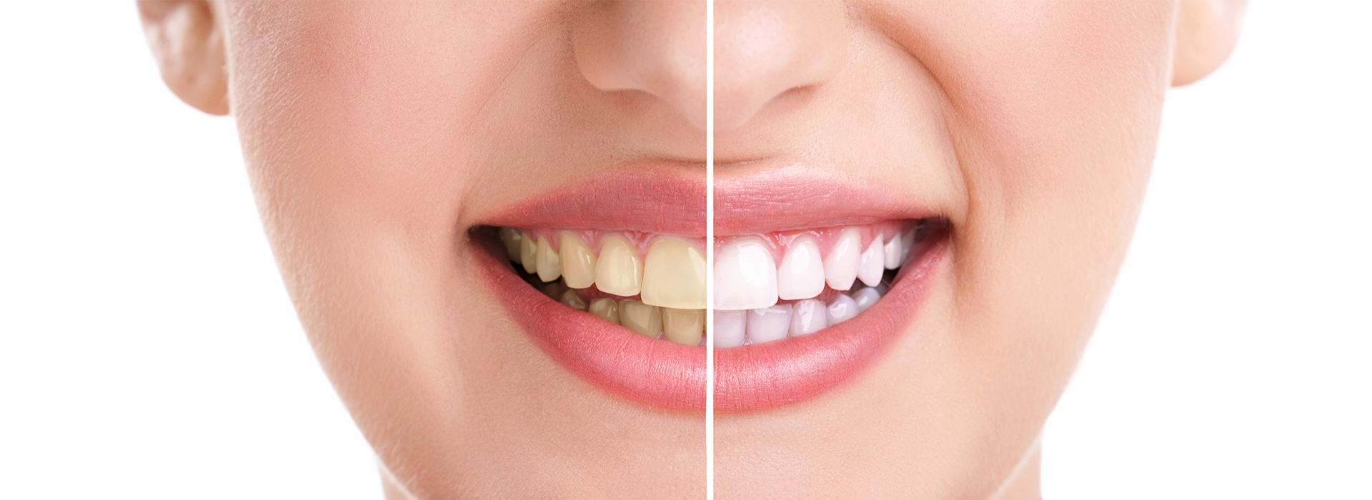 Granger Dentistry | Implant Dentistry, Digital Radiography and Fluoride Treatment