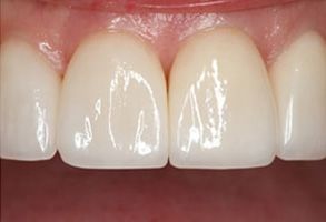 Granger Dentistry | Veneers, Orthodontics and Crowns  amp  Caps