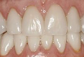 Granger Dentistry | LANAP reg , Air Abrasion and All-on-4 reg 